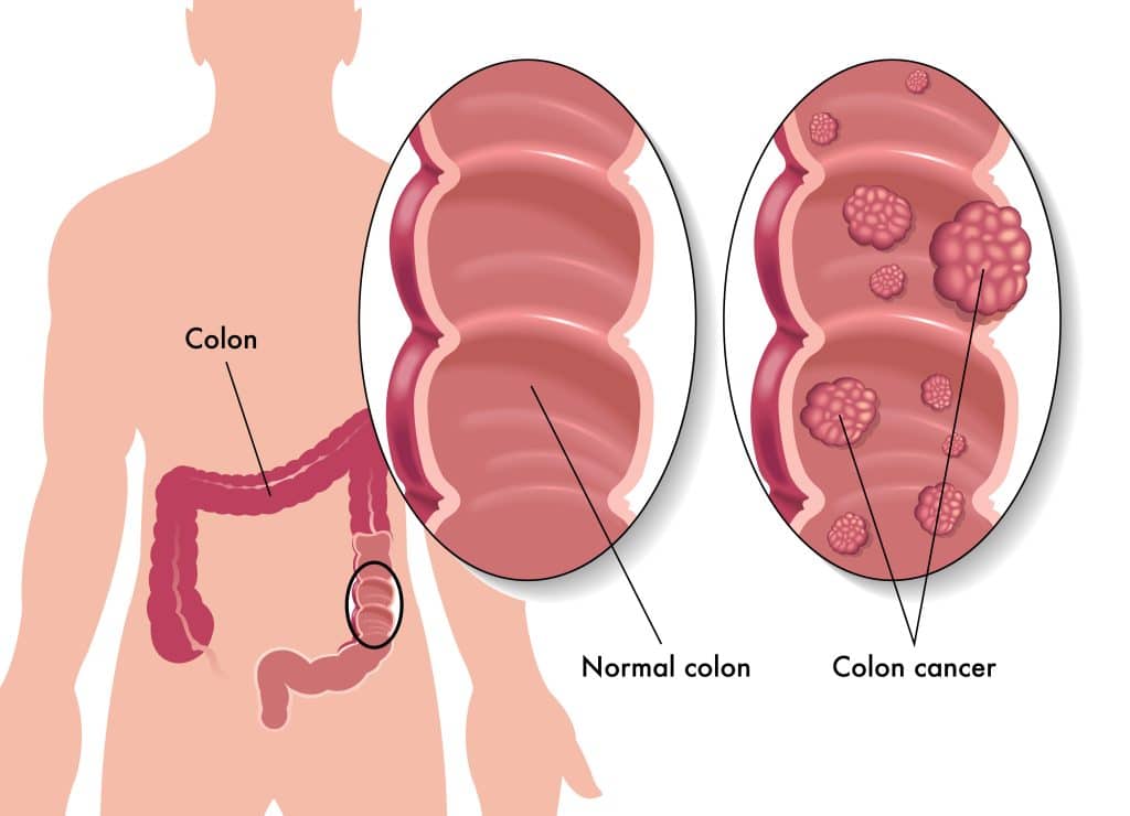 Can we differentiate between symptoms of haemorrhoids (Piles) and  colorectal cancer?