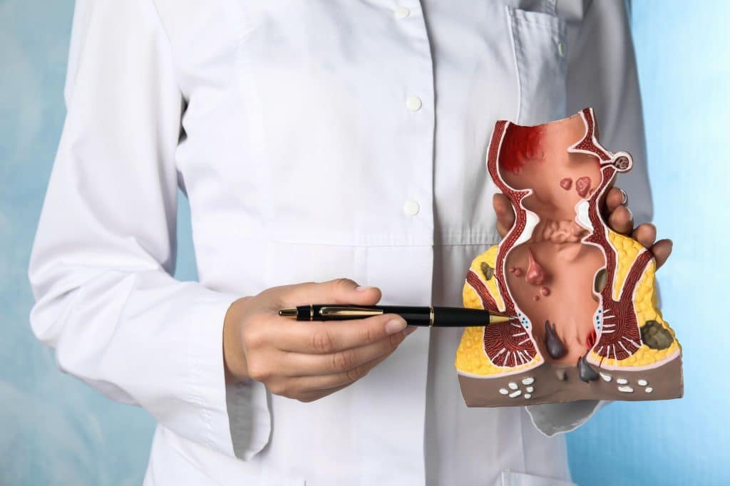 banding hemorrhoids faq