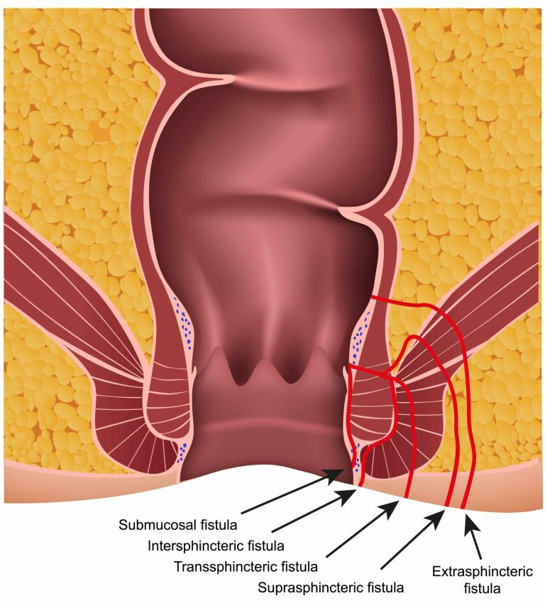How To Heal A Fistula Without Surgery Surgical And Nonsurgical