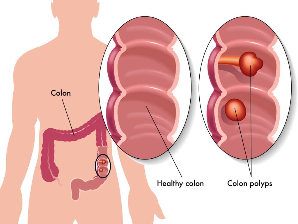 Get Screened for Colon Cancer Polyps
