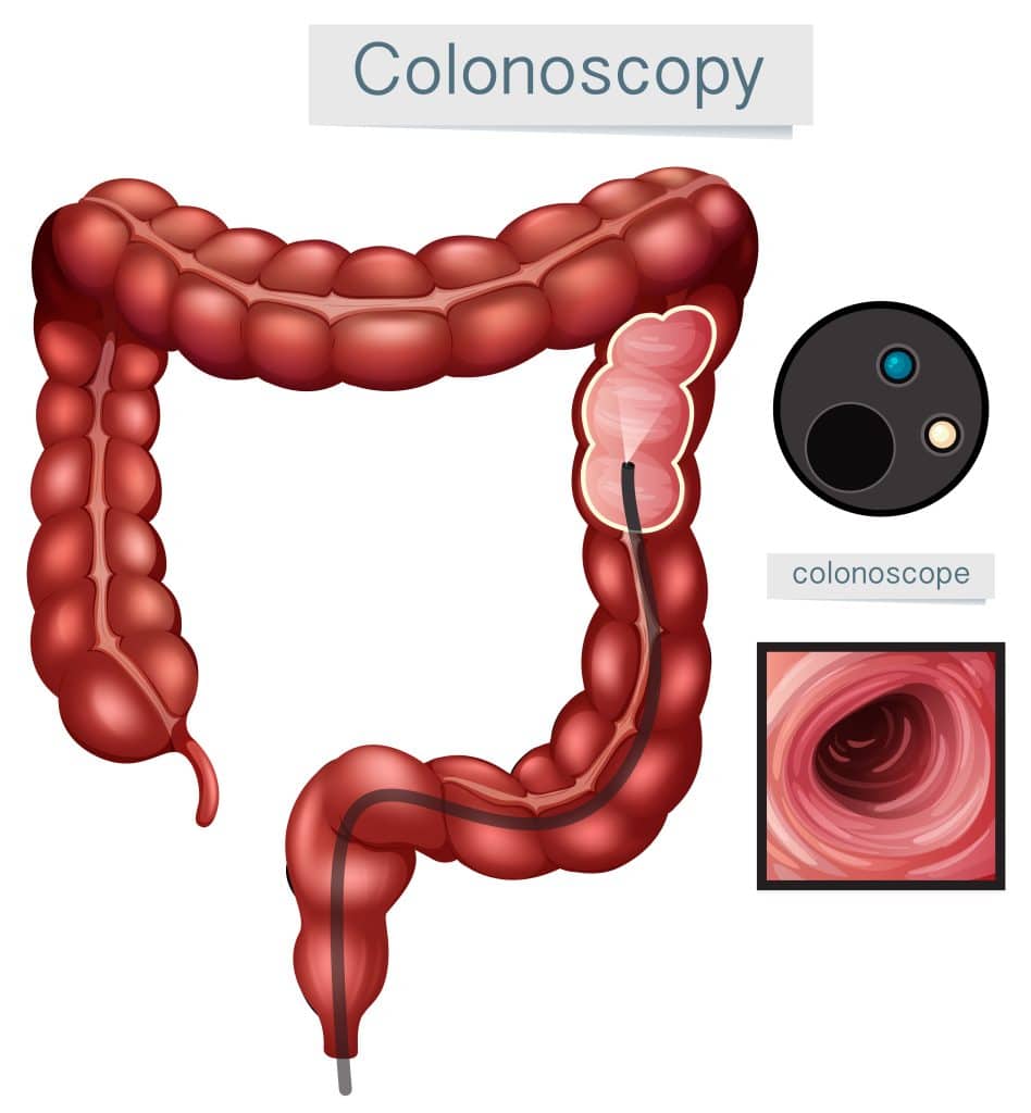 What is a Colonoscopy 2