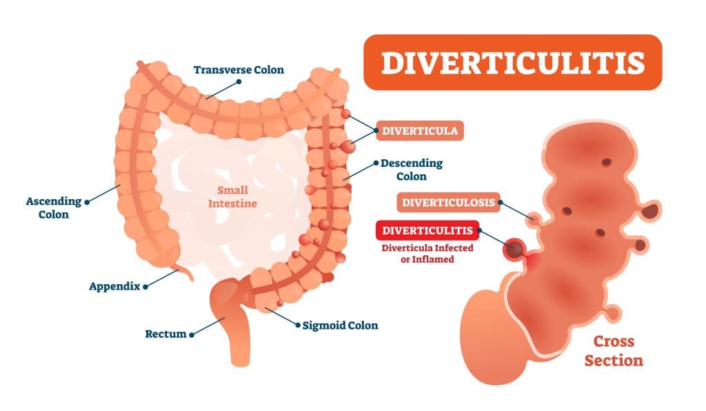 diverticulitis and hemorrhoids