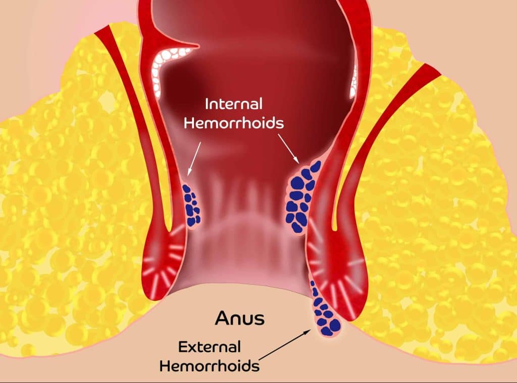 diverticulitis and hemorrhoids