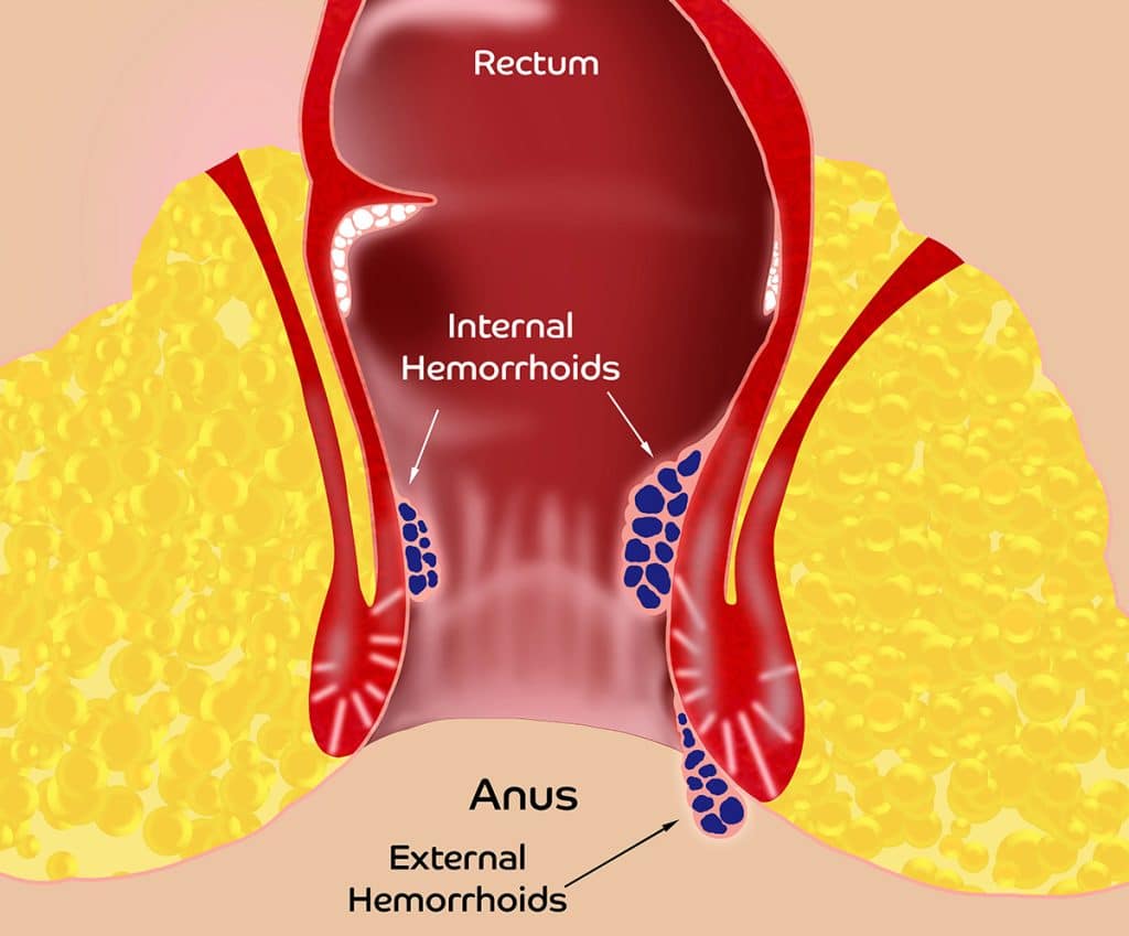 internal and external hemorrhoids scaled 1