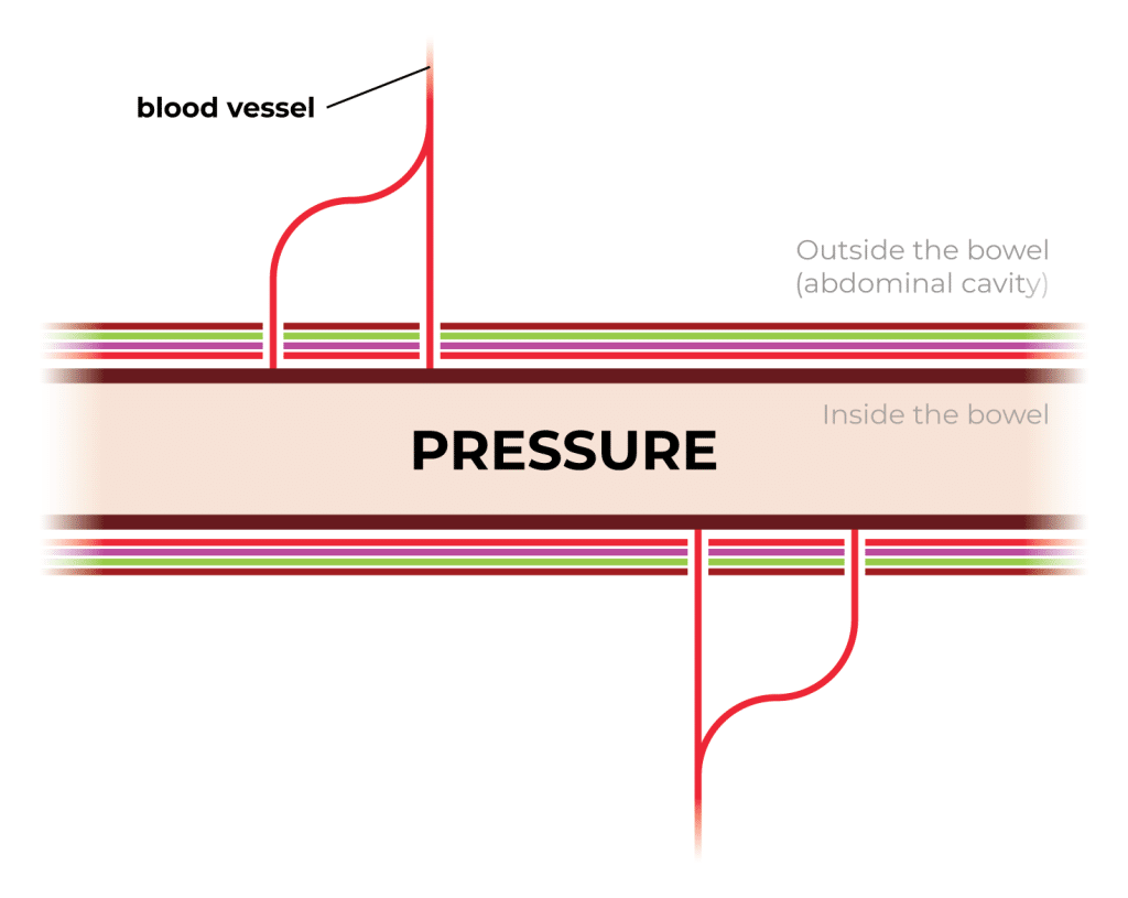 TOP Diverticulosis Diagram 01