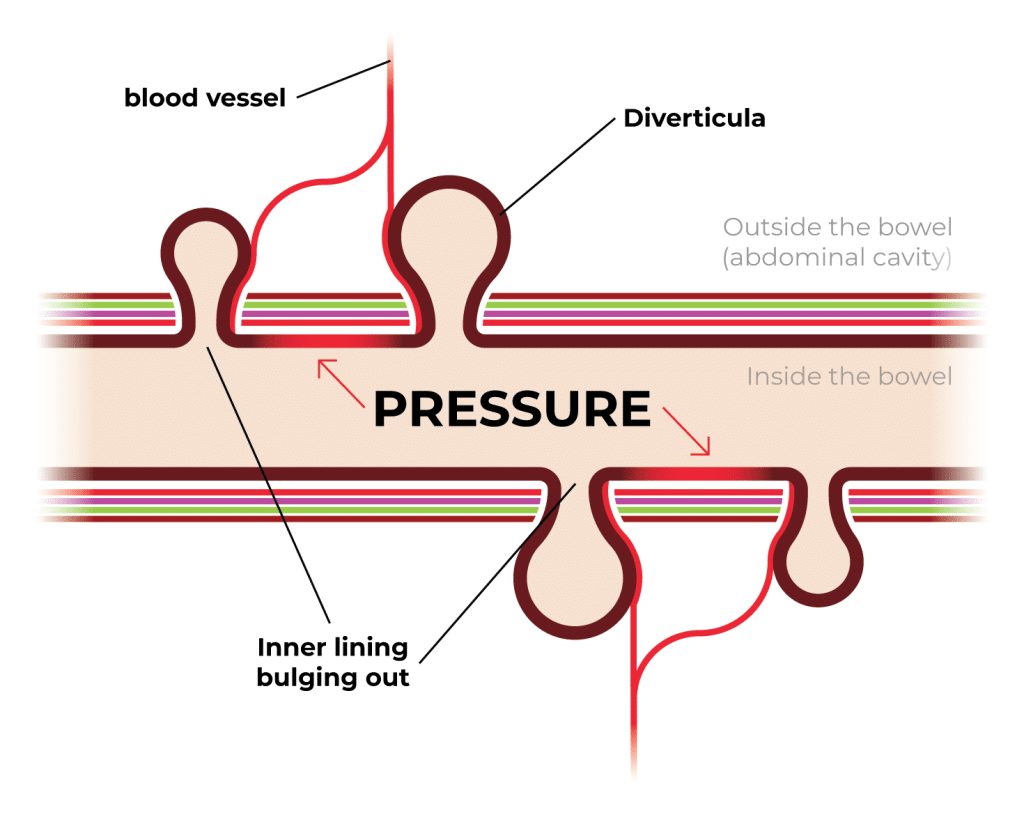 TOP Diverticulosis Diagram 02