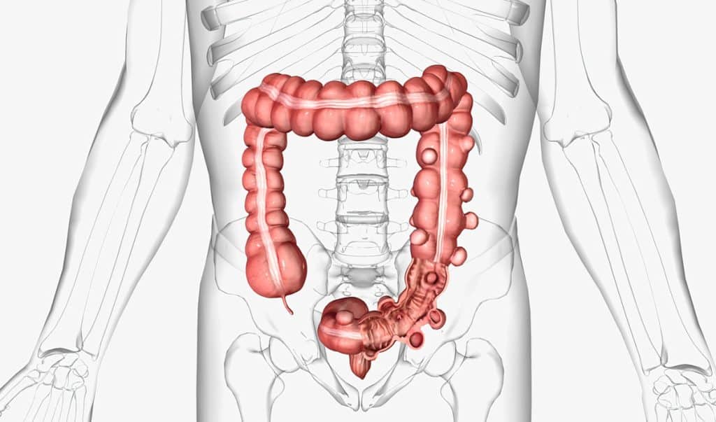 diverticulosis vs diverticulitis