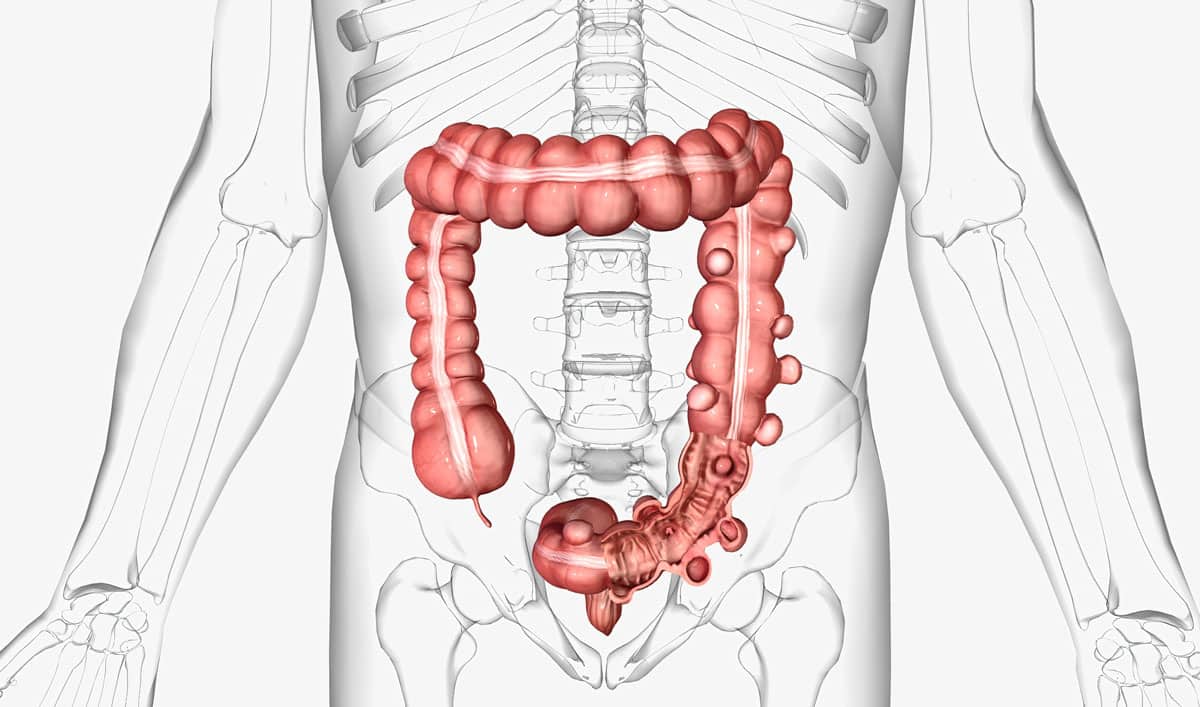 diverticulosis vs diverticulitis