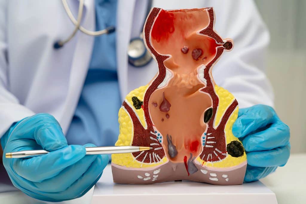 proctologist and hemorrhoids