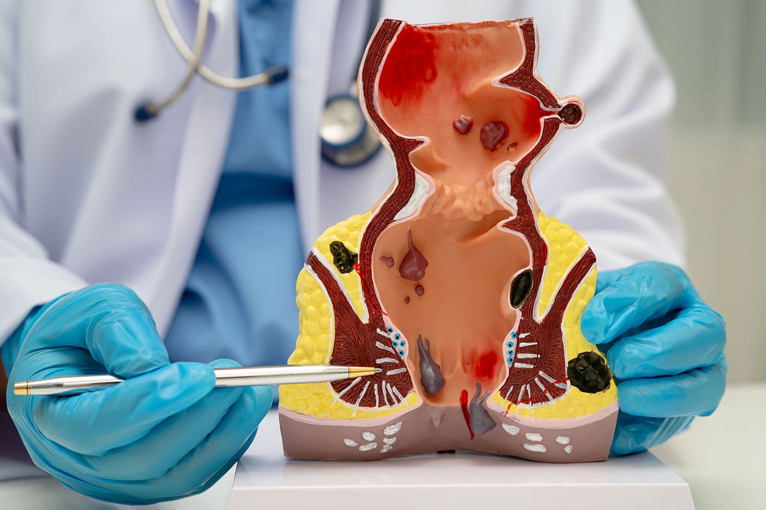 proctologist and hemorrhoids